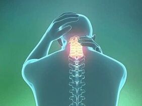 Симптомом шейного остеохондроза является головная боль