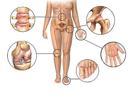артроз поражает различные суставы
